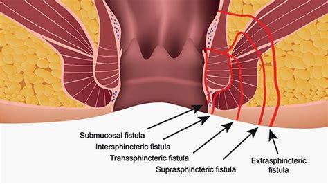 Fistula Ani: Pengertian, Gejala, Penyebab, dan Cara Mengobati | Orami