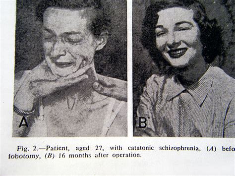 21 Disturbing Pictures of Lobotomy Before and After | Bored Panda