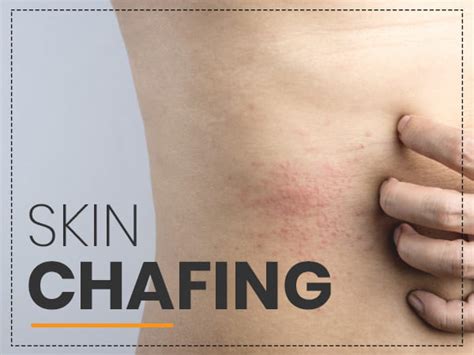 Chafing: Causes, Symptoms, Complications, Treatment & Prevention ...