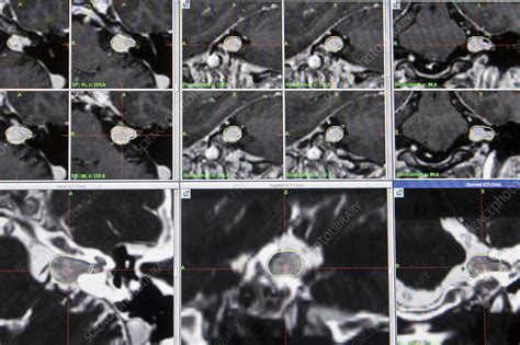 Acoustic neuroma, mri - Stock Image - C006/3803 - Science Photo Library