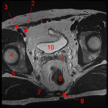 Male Pelvis Magnetic Resonance Imaging - W-Radiology