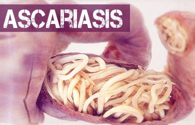 Ascariasis - Causes, Symptoms, Signs, Diagnosis, Treatment, Prevention