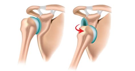 Dislocated Shoulder - Diagnosis, Causes, Treatment & Rehabilitation