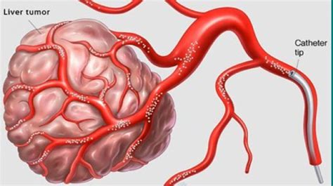 CHEMOEMBOLIZATION (TACE) IN CANCER