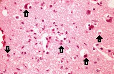 IPLab:Lab 8:HSV Encephalitis - Pathology Education Instructional Resource