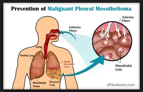 Why People Aren't Talking About Pleural Mesothelioma Stages and What ...