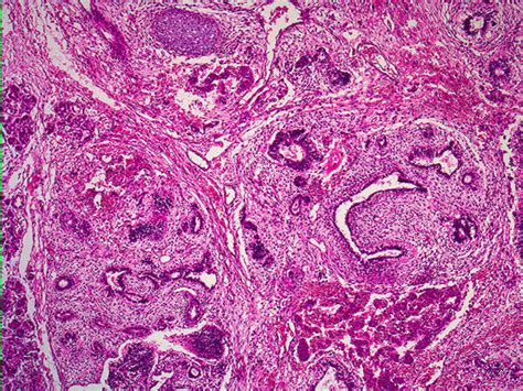 Immature Teratoma Histology