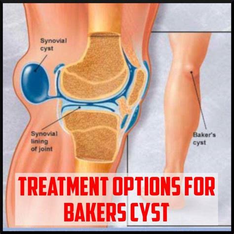 Treatment Options for Bakers Cyst - Sports Medicine Review