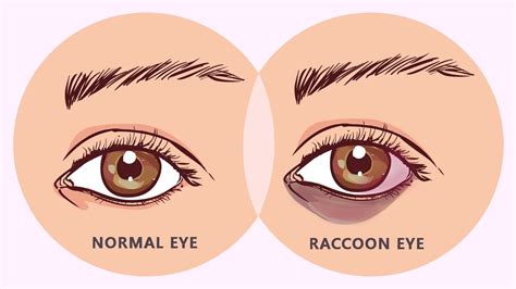 Raccoon Eyes Condition - Its Symptoms, Causes, Complications and More