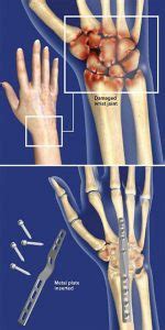 Wrist Fusion (Total Wrist Arthrodesis) | Central Coast Orthopedic Medical Group