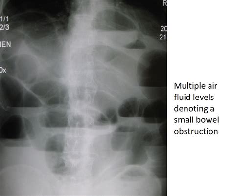 Bowel obstruction X-ray - wikidoc