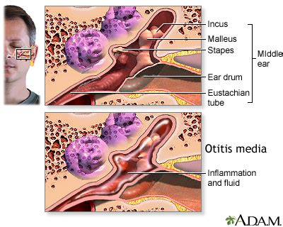 Ear Infection - Middle Ear (Otitis Media) - Symptoms and Causes