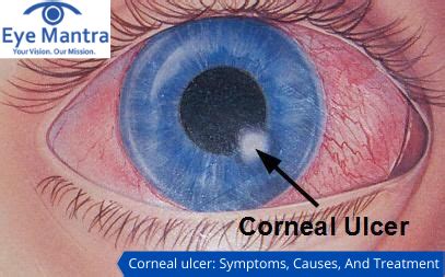 Corneal Ulcer: Symptoms, Causes, And Treatment | EyeMantra