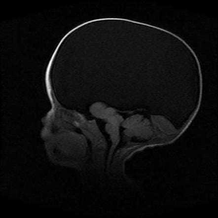 Hydranencephaly Mri