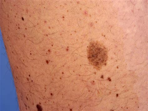 Acquired Melanocytic Nevocellular Nevi - Skin Disorders