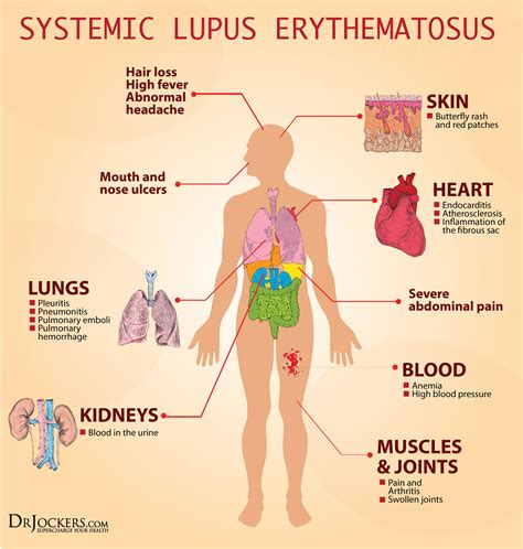 19 Ways to Heal Systemic Lupus Naturally - DrJockers.com