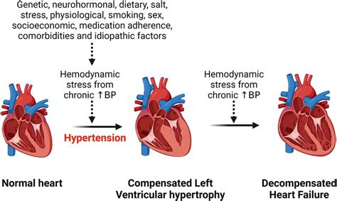 Pathophysiology Of Hypertensive Heart Disease: Beyond Left, 46% OFF