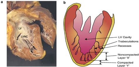 Left Ventricular Noncompaction Cardiomyopathy: From Clinical Features to Animal Modeling ...