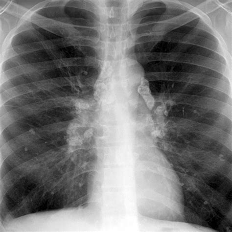 Calcified Hilar Nodes, Remote Granulomatous Infection [1 of 4]