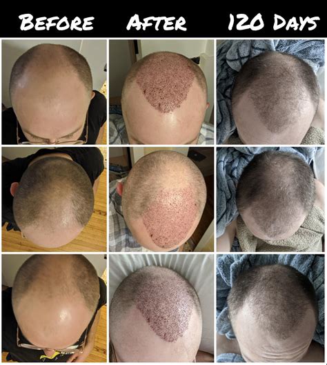 My FUE Hair Transplant Progress So Far : Hairloss