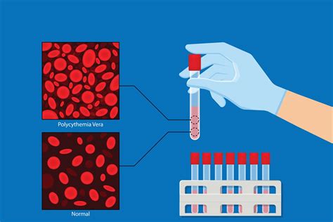 What Is Polycythemia Vera?