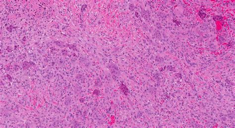 Peripheral giant cell granuloma | Ottawa Atlas of Pathology