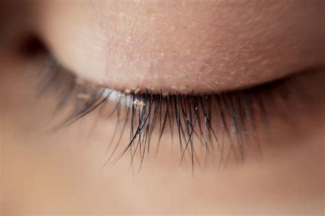 Eyelash Mites: Signs, Causes, and Treatments | MyVision.org