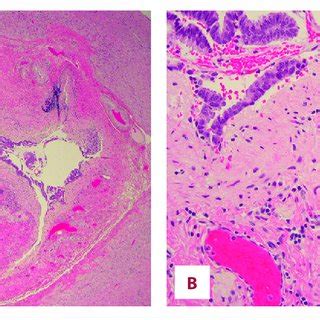 Sections of the appendix demonstrating the histologic appearance of ...