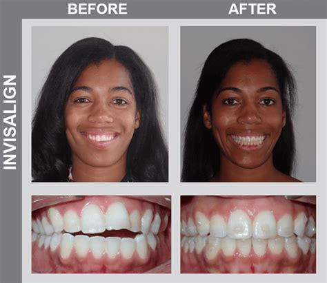 Smile Gallery | Before and Afters | NCOSO Orthodontics