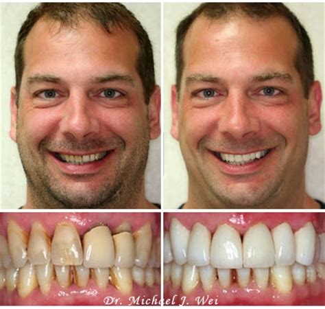 Smile Makeover Cosmetic Dentist by Dr. Michael J. Wei, DDS - Manhattan ...