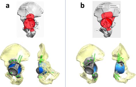 Case example. 3D bony reconstructions of the hemipelvis (defect side)... | Download Scientific ...