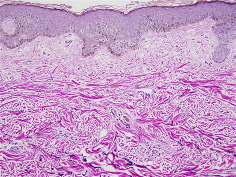 Pseudoxanthoma Elasticum-like Papillary Dermal Elastolysis | Dermatopathology