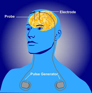 Deep Brain Stimulation - Physiopedia