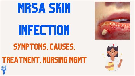 MRSA SKIN INFECTION Causes, Symptoms, Treatment, & Nursing Management ...