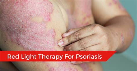 Red Light Therapy for Psoriasis: Does LED Light Therapy Work? | Therapeutic Beams