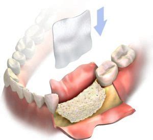 Guided Bone Regeneration Chesapeake VA | Guided Tissue Regeneration