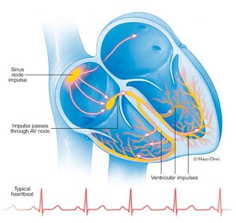 Sick sinus syndrome - Symptoms & causes - Mayo Clinic