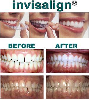 How Much Does Invisalign Cost? - in 2018