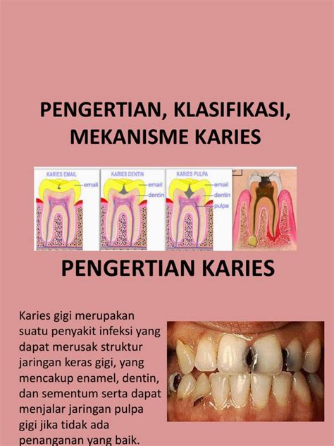 Karies | PDF