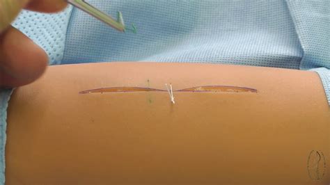 Skin suture removal - YouTube