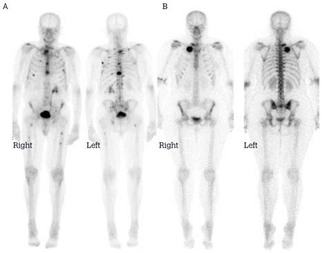 RACGP - Bone scans