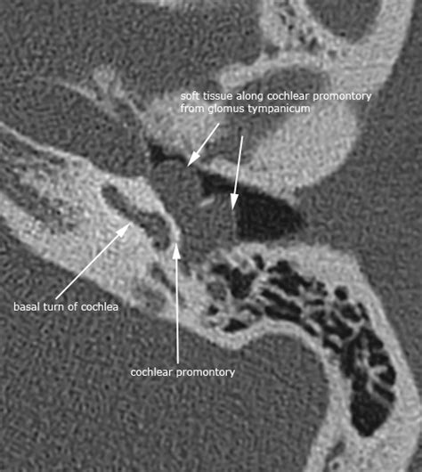 Glomus tympanicum tumor