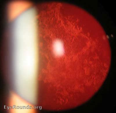 Atlas Entry - Posterior capsular opacity (PCO) following cataract surgery