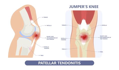 Front of knee pain: causes to think about - Sport Doctor London