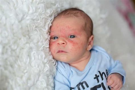 Baby Acne: Treatment and Causes - Mommybites