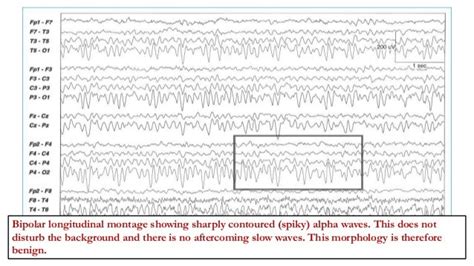 Abnormal focal eeg patterns