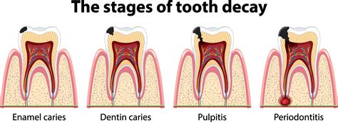 6 Signs of Dental Cavities — WoodSprings Dentistry