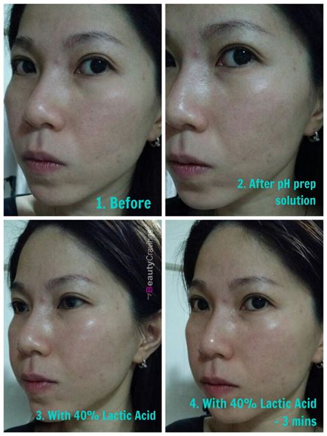 Review - At-Home 40% Lactic Acid Peel (MUAC) » myBeautyCravings