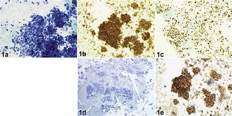 a SCLC with small-sized cells, high N/C ratio, nuclear hyperchromasia,... | Download Scientific ...