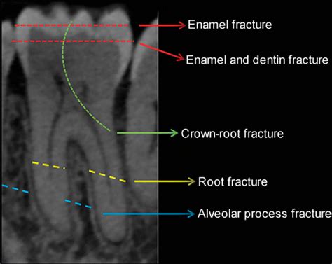 Dental Emergencies: A Practical Guide | RadioGraphics